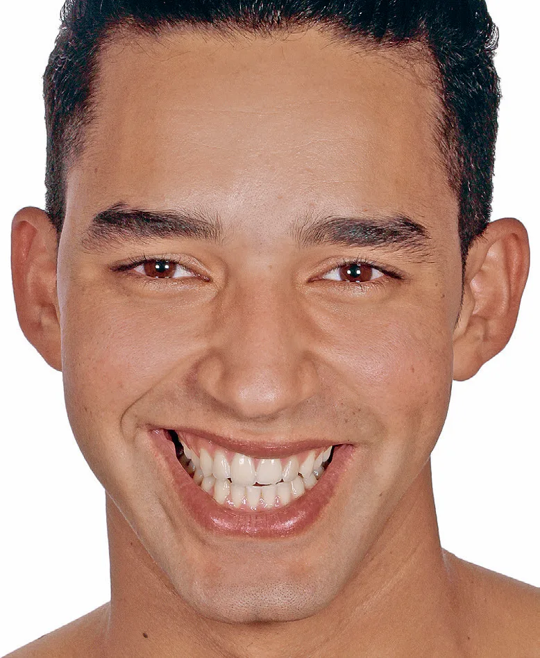 Asimetría oral durante la sonrisa (caso 9). El análisis traza dos rectángulos verticales del ancho del iris para marcar la posición ideal del corredor bucal, que debe quedar libre de dientes, y una horizontal por las comisuras: en este paciente el corredor bucal derecho es más ancho y la comisura derecha más alta que la izquierda. Son dos problemas distintos y se tratan por separado. Flávio 2018, figura 4-18.